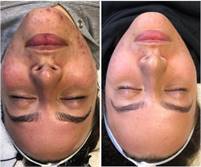 NKD Beauty by Vanessa|Facials |Microneedling Miami NKD  Beauty